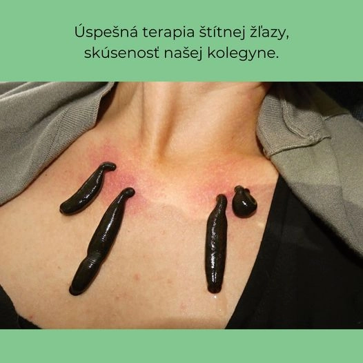 Hirudoterapie a štítná žláza je dobrou kombinací. Pijavice lékařské svými účinky podporují v těle ústup zánětu a normalizují funkce.