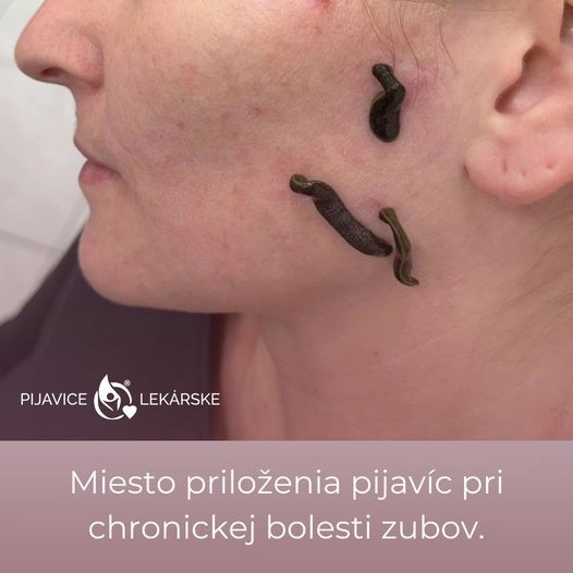 Hirudoterapie skvělý pomocník při chronické bolesti zubů. Svými účinky stahuje infekci, potlačuje bolest a zánět v těle.